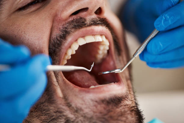Best Emergency Wisdom Tooth Extraction in Forest Heights, MD